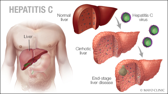 Hepatitis C Initiative